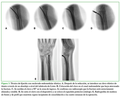 Técnica de fijación con enclavado endomedular elástico. A. Después de la reducción se introduce un clavo elástico de titanio a través de un abordaje a nivel del tubérculo de Lister. B. Colocación del clavo en el canal endomedular que haya atravesado la fractura. C. Se moldea el clavo a 90° en la zona de ingreso. Se confirma con radioscopia que la fractura está correctamente alineada y estable. D. Se corta el clavo con el dispositivo y se coloca el capuchón protector (endcap). E.Radiografías de muñeca de frente y de perfil que muestran signos incipientes de consolidación a las cuatro semanas de la operación. 