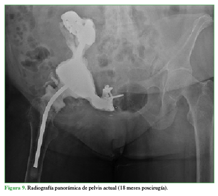 Radiografía panorámica de pelvis actual (18 meses poscirugía).