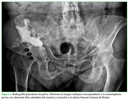 Radiografía panorámica de pelvis. Obsérvese la imagen radiopaca correspondiente a la cementoplastia previa, con alteración lítica alrededor del cemento y extensión a la cabeza femoral (cabezas de flecha).