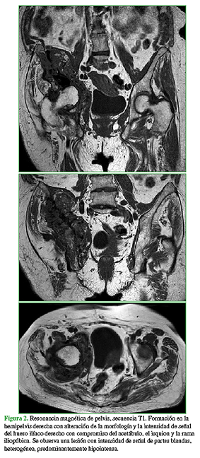 Resonancia magnética de pelvis, secuencia T1. Formación en la hemipelvis derecha con alteración de la morfología y la intensidad de señal del hueso ilíaco derecho con compromiso del acetábulo, el isquión y la rama iliopúbica. Se observa una lesión con intensidad de señal de partes blandas, heterogénea, predominantemente hipointensa. 