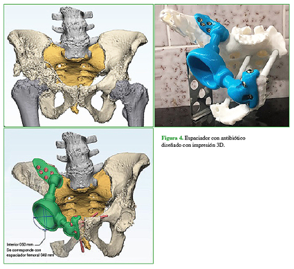 Espaciador con anibiótico diseñado con impresión 3D.
