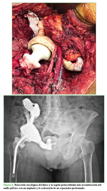 Resección oncológica del ilíaco y la región periacetabular más reconstrucción del anillo pélvico con un implante y la colocación de un espaciador preformado. 