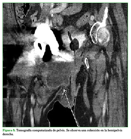 Tomografía computarizada de pelvis. Se observa una colección en la hemipelvis derecha. 