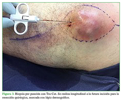 Biopsia por punción con Tru-Cut. Se realiza longitudinal a la futura incisión para la resección quirúrgica, marcada con lápiz dermográfico. 