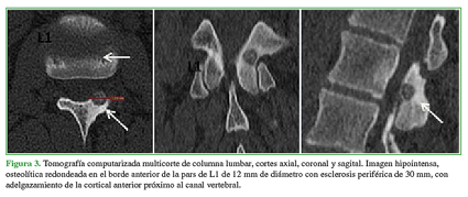 Tomografía computarizada multicorte de columna lumbar, cortes axial, coronal y sagital. Imagen hipointensa, osteolítica redondeada en el borde anterior de la pars de L1 de 12mm de diámetro con esclerosis periférica de 30mm, con adelgazamioento de la cortical anterior próximo al canal vertebral.