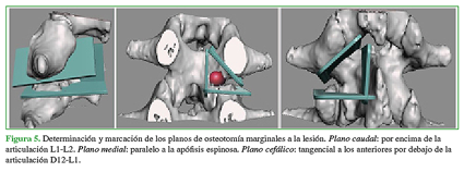 Determinación y marcación de los planos de osteotomía marginales a la lesión. Plano caudal: por encima de la articulación L1-L2. Plano medial: paralelo a la apófisis espinosa. Plano cefálico: tangencial a los anteriores por debajo de la articulación D12-L1.