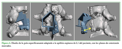 Diseño de la guía específicamente adaptada a la apófisis espinosa de L1 del paciente, con los planos de osteotomía marcados.  