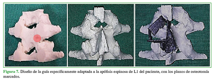 Diseño de la guía específicamente adaptada a la apófisis espinosa de L1 del paciente, con los planos de osteotomía marcados.