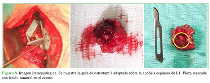 Imagen intraquirúrgica. Se muestra la guía de osteotomía adaptada sobre la apófisis espinosa de L1. Pieza resecada con lesión tumoral en el centro.