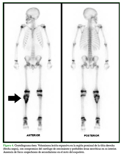 Centellograma óseo. Voluminosa lesión expansiva en la región proximal ded la tibia derecha (flecha negra), con compromiso del cartílago de crecimiento y probables áreas necróticas en su interior.  Ausencia de focos sospechosos de secundarismo en el resto del esqueleto. 