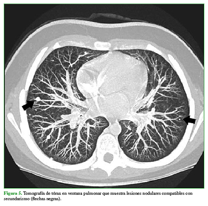 Tomografía de tórax en ventana pulmonar que muestra lesiones nodulares compatibles con secundarismo (flechas negras).