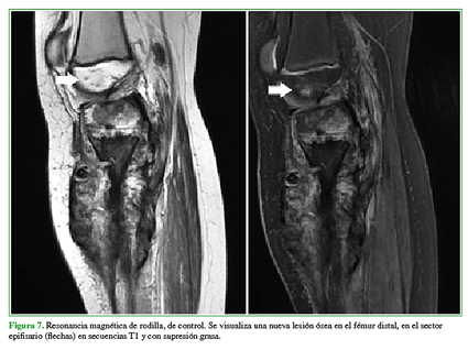 Resonancia magnética de rodilla, de control. Se visualiza una nueva lesión ósea en el fémur distal, en el sector epifisario (flechas) en secuencias T1 y con supresión grasa. 