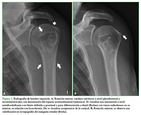 Radiografía de hombro izquierdo. A. Rotación interna: cambios artrósicos a nivel glenohumeral y acromioclavicular, con disminución del espacio acromiohumeral (asterisco). Se visualiza una tumoración a nivel metafisodiafisario con límite definido a proximal y poca diferenciación a distal (flechas) con trazos radiodensos en su interior, en relación con la esclerosis. No se visualiza compromiso de la cortical. B. Rotación externa: se observa una calcificación en la topografía del manguito rotador (flecha). 