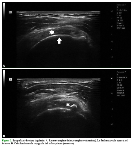 Ecografía de hombro izquierdo: A. Rotura completa del supraespinoso (asterisco). La flecha marca la cortical del húmero. B. Calcificación en la topografía del infraespinoso (asterisco). 