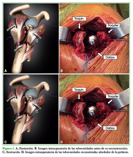 A. Ilustración. B. Imagen intraoperatoria de las tuberosidades antes de su reconstrucción. C. Ilustración. D. Imagen intraoperatoria de las tuberosidades reconstruidas alrededor de la prótesis. 