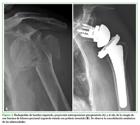 Radiografías de hombro izquierdo, proyección anteroposterior preoperatoria (A) y al año de la cirugía de una fractura de húmero proximal izquierdo tratada con prótesis invertida (B). Se observa la consolidación anatómica de las tuberosidades. 