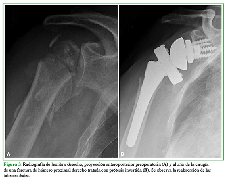 Radiografía de hombro derecho, proyección anteroposterior preoperatoria (A) y al año de la cirugía de una fractura de húmero proximal derecho tratada con prótesis invertida (B). Se observa la reabsorción de las tuberosidades.
