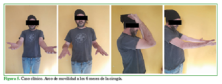 Caso clínico. Arco de movilidad a los 6 meses de la cirugía. 