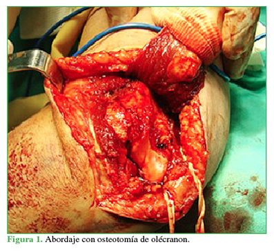 Abordaje con osteotomía de olécranon.