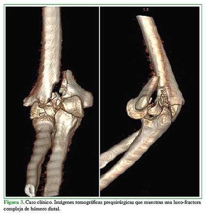 Caso clínico. Imágenes tomográficas prequirúrgicas que muestran una luxo-fractura compleja de húmero distal.