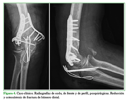 Caso clínico. Radiografías de codo, de frente y de perfil, posquirúrgicas. Reducción y osteosíntesis de fractura de húmero distal. 