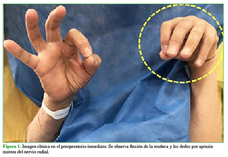 Imagen clínica en el preoperatorio inmediato. Se observa flexión de la muñeca y los dedos por apraxia motora del nervio radial. 