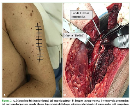 A. Marcación del abordaje lateral del brazo izquierdo. B. Imagen intraoperatoria. Se observa la compresión del nervio radial por una arcada fibrosa dependiente del tabique intermuscular lateral. El nervio radial está congestivo. 
