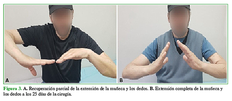 A. Recuperación parcial de la extensión de la muñeca y los dedos. B. Extensión completa de la muñeca y los dedos a los 25 días de la cirugía. 