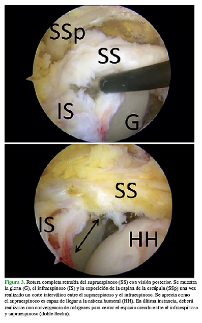 Rotura completa retraída del supraespinoso (SS) con visión posterior. Se muestra la glena (G), el infraespinoso (IS) y la exposición de la espina de la escápula (SSp) una vez realizado un corte interválico entre el supraespinoso y el infraespinoso. Se aprecia como el supraespinoso es capaz de llegar a la cabeza humeral (HH). En última instancia, deberá realizarse una convergencia de márgenes para cerrar el espacio creado entre el infraespinoso y supraespinoso (doble flecha).  