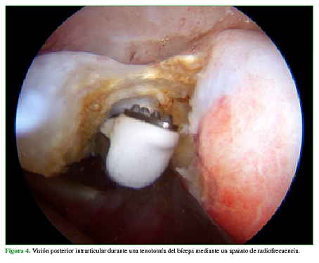 Visión posterior intrarticular durante una tenotomía del bíceps mediante un aparato de radiofrecuencia. 