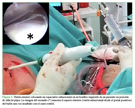 Visión exterior colocando un espaciador subacromial en un hombro izquierdo de un paciente en posición de silla de playa. La imagen del recuadro (*) muestra el aspecto interior (visión subacromial desde el portal posterior) del balón una vez insuflado con el suero estéril. 