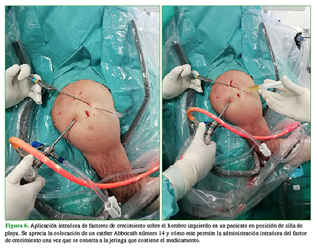 Aplicación intraósea de factores de crecimiento sobre el hombro izquierdo en un paciente en posición de silla de playa. Se aprecia la colocación de un catéter Abbocath número 14 y cómo éste permite la administración intraósea del factor de crecimiento una vez que se conecta a la jeringa que contiene el medicamento.