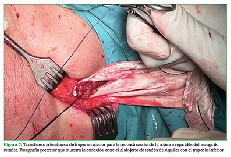 Transferencia tendinosa de trapecio inferior para la reconstrucción de la rotura irreparable del manguito rotador. Fotografía posterior que muestra la conexión entre el aloinjerto de tendón de Aquiles con el trapecio inferior. 