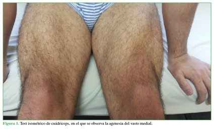 Test isométrico de cuádriceps, en el que se observa la agenesia del vasto medial. 