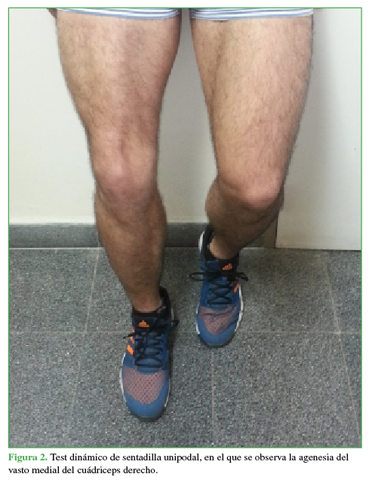 Test dinámico de sentadilla unipodal, en el que se observa la agenesia del vasto medial del cuádriceps derecho.