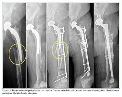 Fractura femoral periprotésica con trazo de fractura a nivel del tallo, tratada con osteosíntesis y falla. Revisión con prótesis de fijación distal y aloinjerto. 