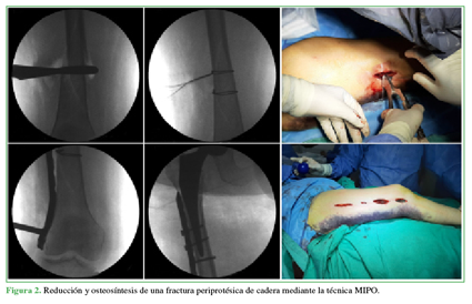 Reducción y osteosíntesis de una fractura periprotésica de cadera mediante la técnica MIPO.