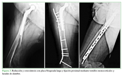 Reducción y osteosíntesis con placa bloqueada larga y fijación proximal mediante tornillos monocorticales y lazadas de alambre. 