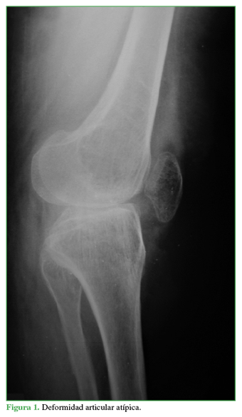 Deformidad articular atípica.