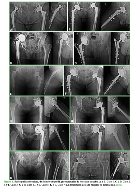 Radiografías de cadera, de frente y de perfil, preoperatorias de los casos tratados. A y B. Caso 1. C y D. Caso 2. E y F. Caso 3. G y H. Caso 4. I y J. Caso 5. K y L. Caso 7. La descripción de cada paciente se detalla en la Tabla