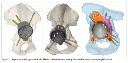 Representación y planificación 3D del cotilo tridimensional y los tornillos de fijación ejemplificativos. 