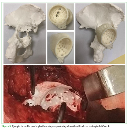 Ejemplo de molde para la planificación preoperatoria y el molde utilizado en la cirugía del Caso 1. 