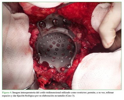 Imagen intraoperatoria del cotilo tridimensional utilizado como restrictor; permite, a su vez, rellenar espacios y dar fijación biológica por su elaboración en tantalio (Caso 3). 