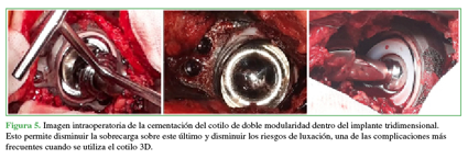 Imagen intraoperatoria de la cementación del cotilo de doble modularidad dentro del implante tridimensional. Esto permite disminuir la sobrecarga sobre este último y disminuir los riesgos de luxación, una de las complicaciones más frecuentes cuando se utiliza el cotilo 3D. 