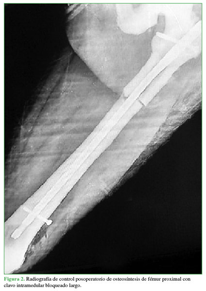 Radiografía de control posoperatorio de osteosíntesis de fémur proximal con clavo intramedular bloqueado largo. 