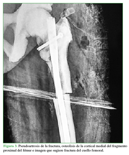 Pseudoartrosis de la fractura, osteolisis de la cortical medial del fragmento proximal del fémur e imagen que sugiere fractura del cuello femoral. 