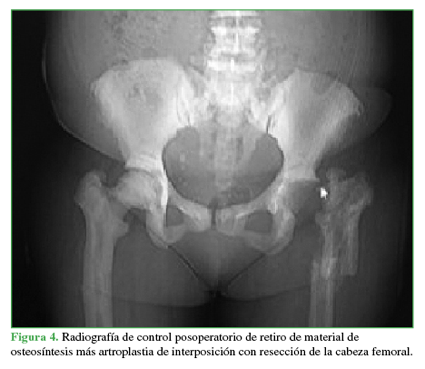Radiografía de control posoperatorio de retiro de material de osteosíntesis más artroplastia de interposición con resección de la cabeza femoral.