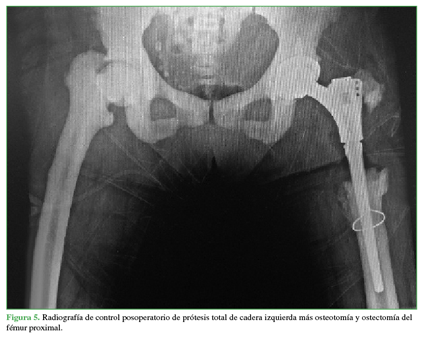 Radiografía de control posoperatorio de prótesis total de cadera izquierda más osteotomía y ostectomía del fémur proximal.