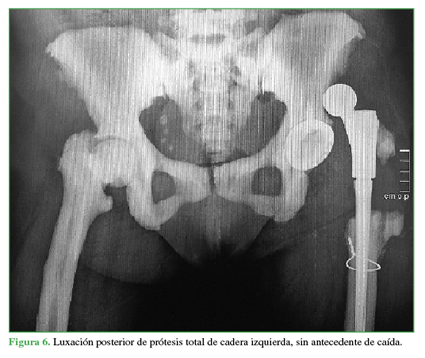 Luxación posterior de prótesis total de cadera izquierda, sin antecedente de caída. 