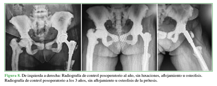 De izquierda a derecha: Radiografía de control posoperatorio al año, sin luxaciones, aflojamiento u osteolisis. Radiografía de control posoperatorio a los 3 años, sin aflojamiento u osteolisis de la prótesis.  